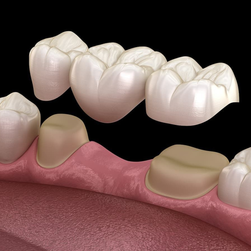 Custom fitted dentures and dental bridges at Yoha Dental Clinic