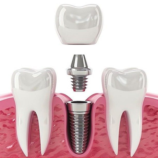 Advanced dental implant technology at Yoha Dental Clinic
