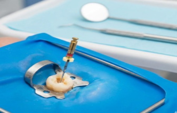 A professional endodontic root canal procedure being performed safely and hygienically using a rubber dental dam.