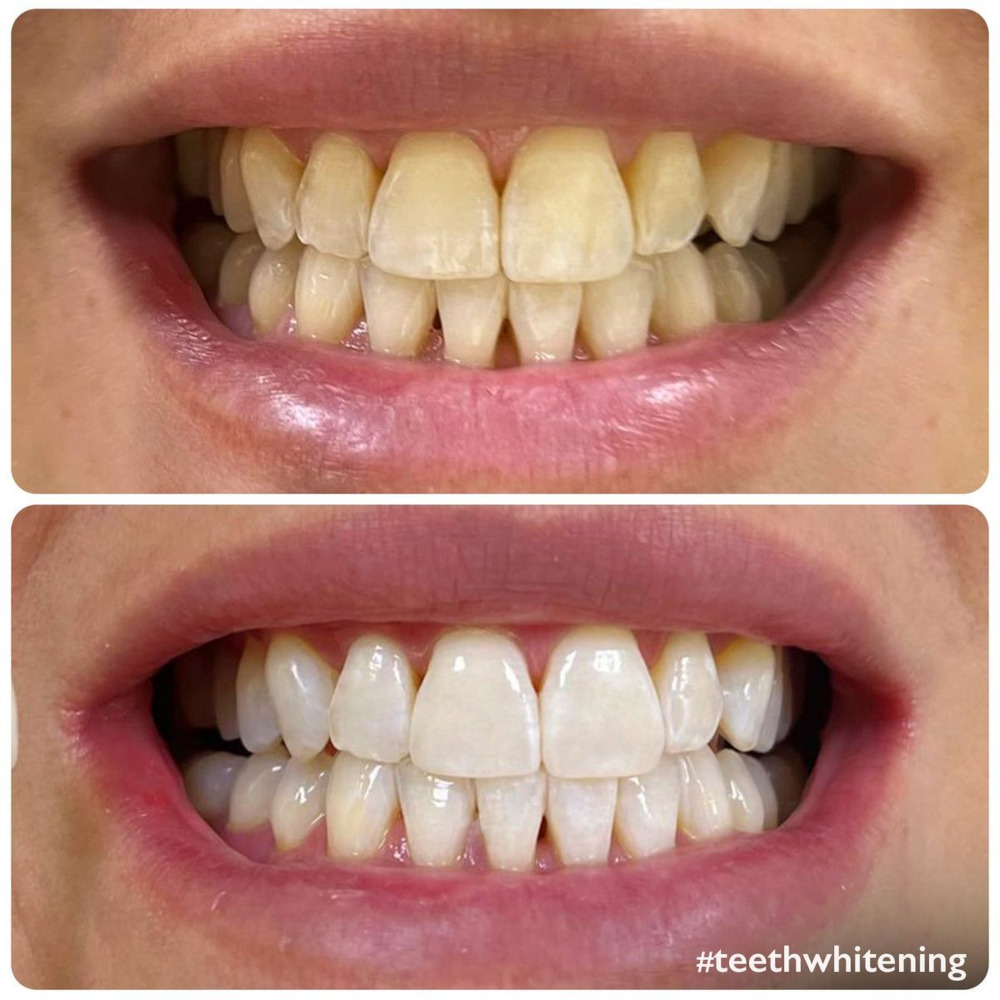 Bright smile result from teeth whitening at Yoha Dental Clinic