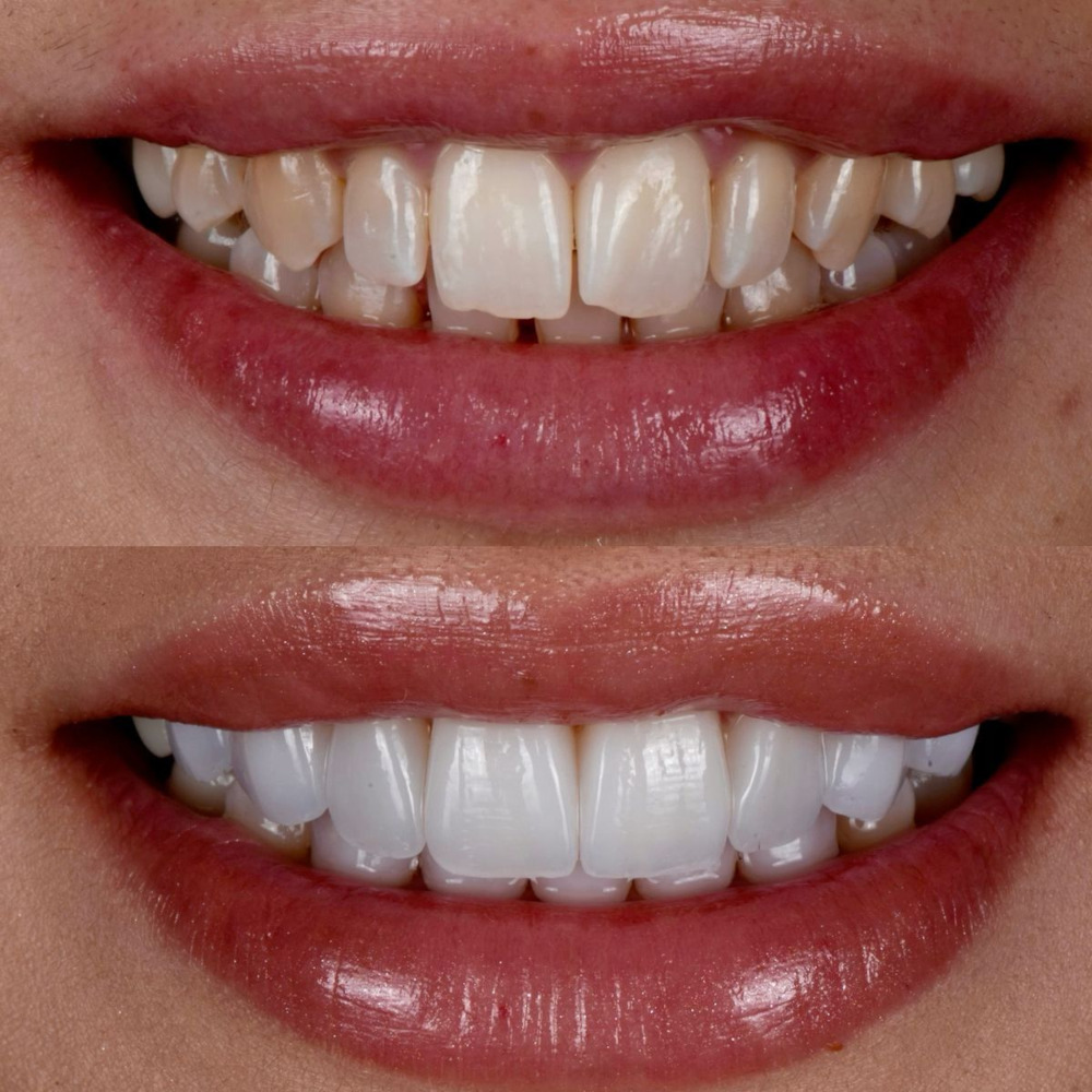 Custom veneers for smile enhancement at Yoha Dental Clinic